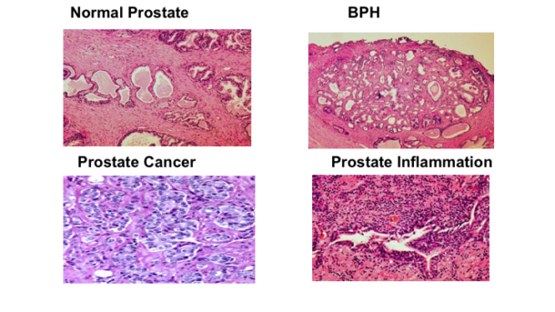 Prostate Inflammation And Prostate Cancer | What Do I Need To Know?