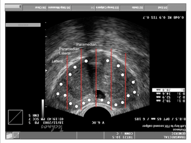 Roberto Miano Md Transperineal Prostate Biopsy State Of The Art