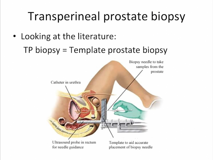 Biopsy on prostate