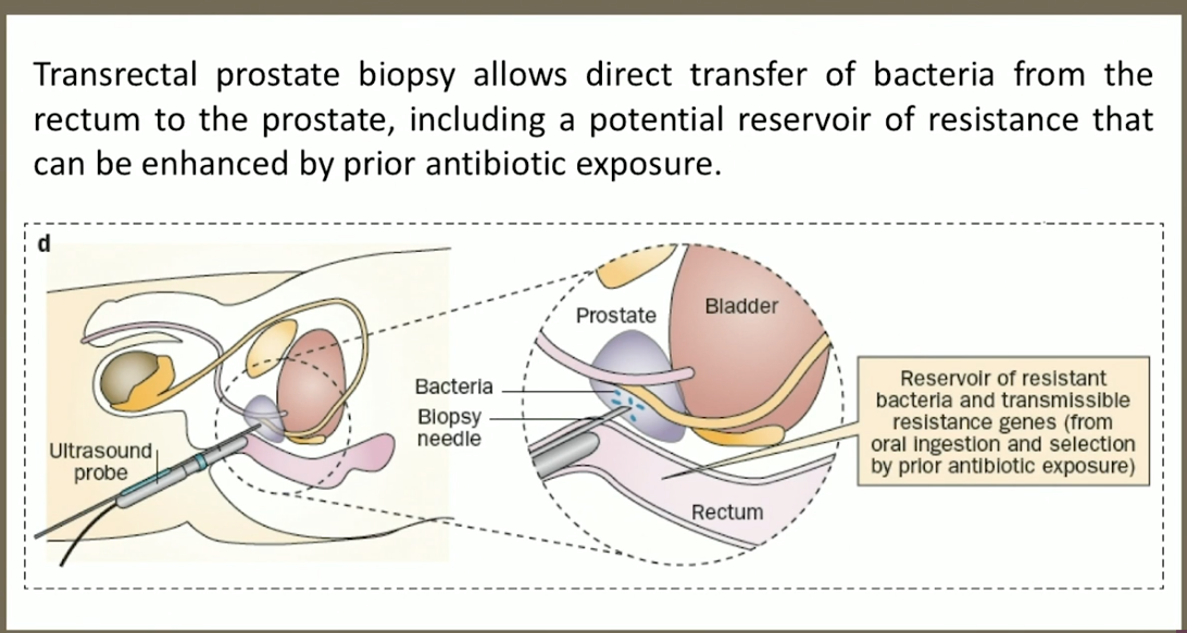 Is prostate biopsy dangerous