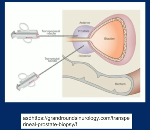 Trus Urology Example Is it Time to Abandon Transrectal Prostate Biopsy?