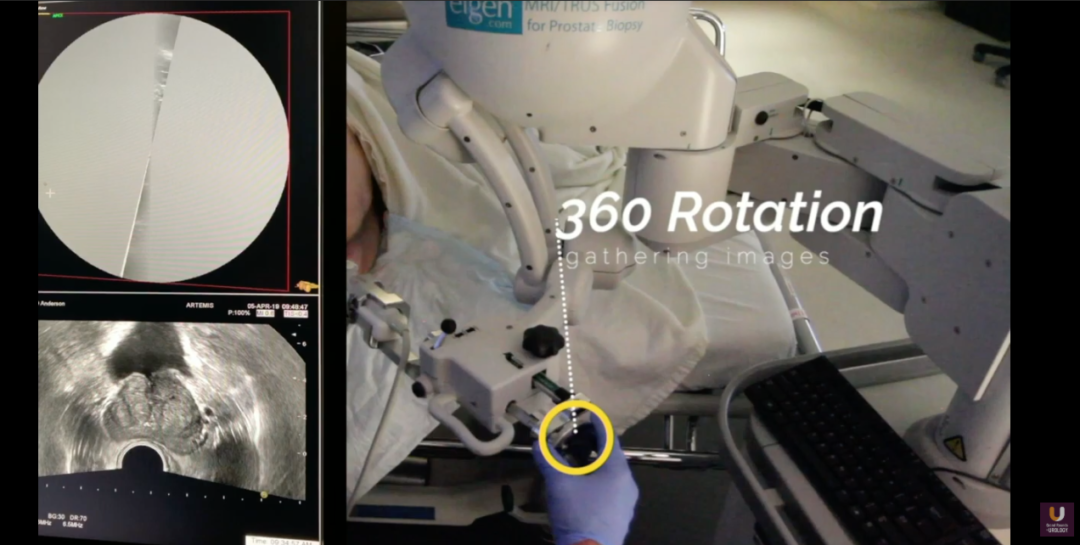 Mri Us Image Fusion Prostate Biopsy Artemis 6486